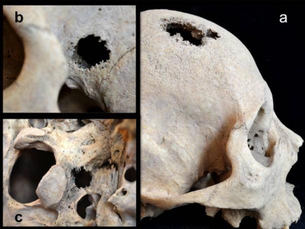 lesions-holes-skull-cancer.jpg